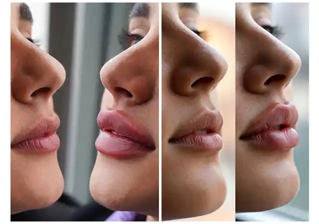 عکس کلوزآپ نیم‌رخ مقایسه قبل و بعد برای نشان دادن نتیجه طبیعی تزریق ژل لب