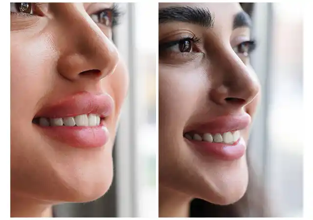 پرتره زن ۲۸ ساله با لب‌های طبیعی پلامپ شده توسط فیلر Juvederm یا Restylane - لبخند ملایم و هماهنگی کامل با صورت